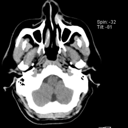 File:Nasolabial cyst (Radiopaedia 28401-28650 Axial non-contrast 2).jpg