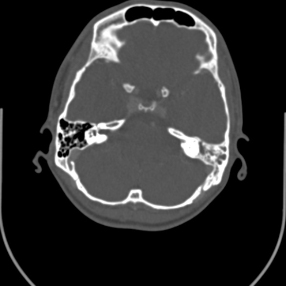 Nasopharyngeal carcinoma with skull base invasion (Radiopaedia 53415-59705 Axial bone window 4).jpg