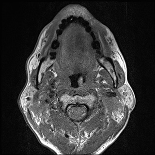 File:Nasopharyngeal carcinoma with skull base invasion (Radiopaedia 59258-66600 B 33).jpg