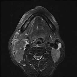 File:Nasopharyngeal carcinoma with skull base invasion (Radiopaedia 59258-66600 D 42).jpg