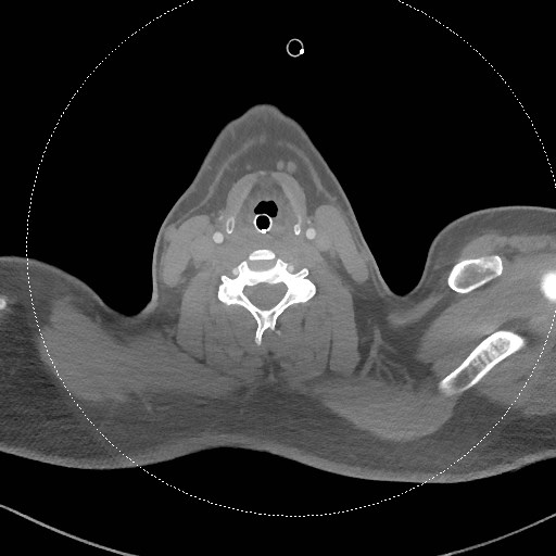 Neck CT angiogram (intraosseous vascular access) (Radiopaedia 55481-61945 B 166).jpg