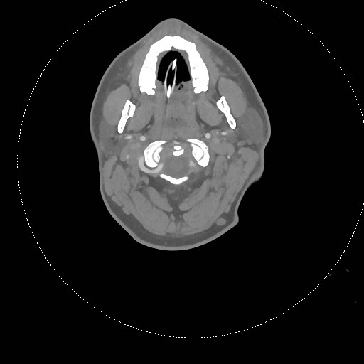 Neck CT angiogram (intraosseous vascular access) (Radiopaedia 55481-61945 B 236).jpg