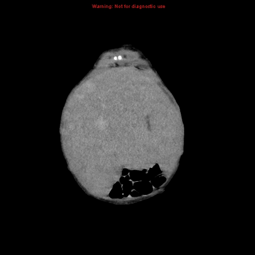 File:Neonatal neuroblastoma (Radiopaedia 9564-10223 B 23).jpg