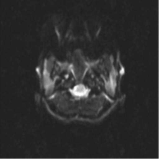 Neurenteric cyst (Radiopaedia 58641-65837 Axial DWI 3).png