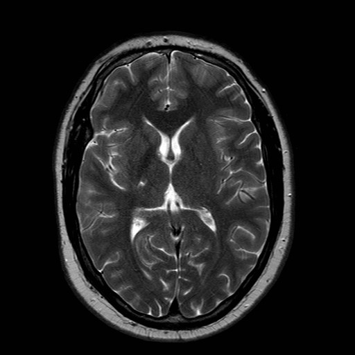 File:Neuro-Behcet's disease (Radiopaedia 21557-21506 Axial T2 15).jpg