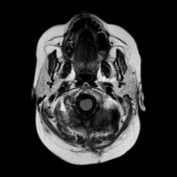 File:Neurofibromatosis type 2 (Radiopaedia 8713-9518 Axial FLAIR 24).jpg