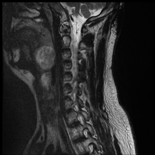 File:Neurofibromatosis type 2 (spinal manifestations) (Radiopaedia 53943-60070 Sagittal T2 4).png