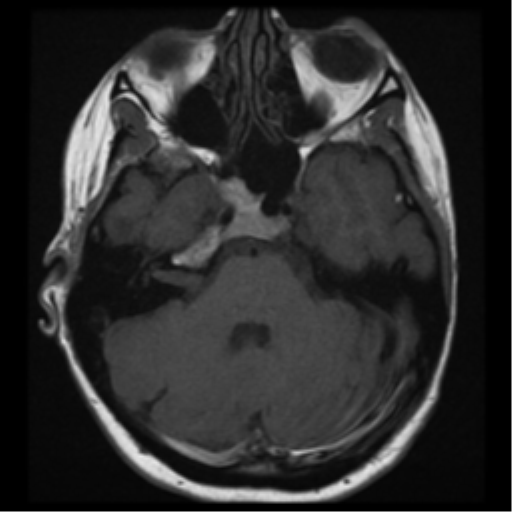 File:Neurofibromatosis type 2 - bilateral acoustic neuromata (Radiopaedia 40060-42566 Axial T1 8).png