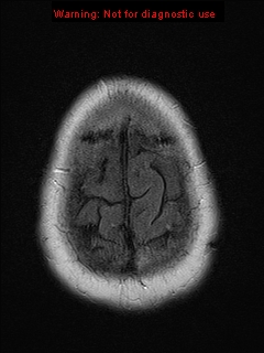 File:Neuroglial cyst (Radiopaedia 10713-11184 Axial FLAIR 2).jpg