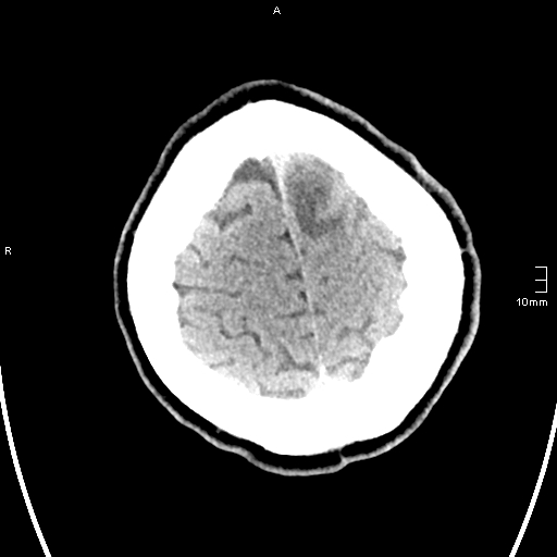 File:Neurotoxoplasmosis - concentric target sign (Radiopaedia 70644-80783 Axial non-contrast 35).jpg
