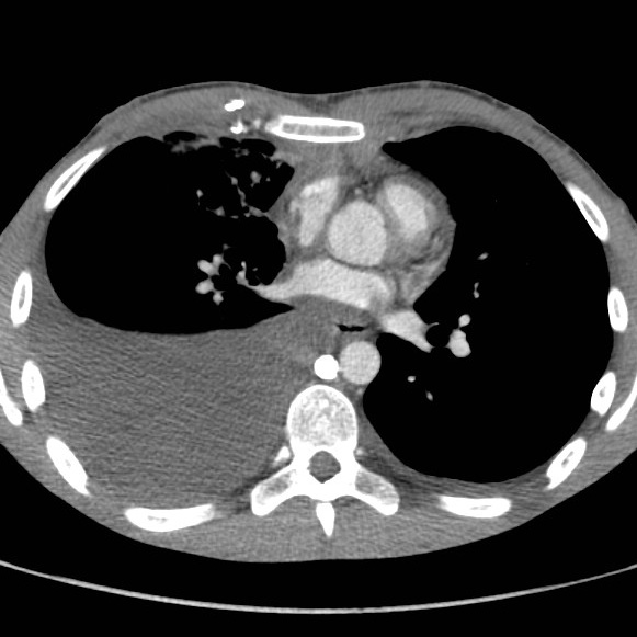 File:Non-Hodgkin lymphoma involving lung (Radiopaedia 29094-29470 B 39).jpg
