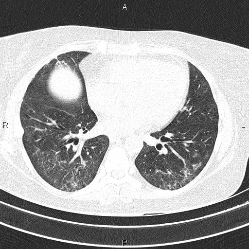 Non-specific interstitial pneumonia (Radiopaedia 83185-97567 Axial lung window 40).jpg