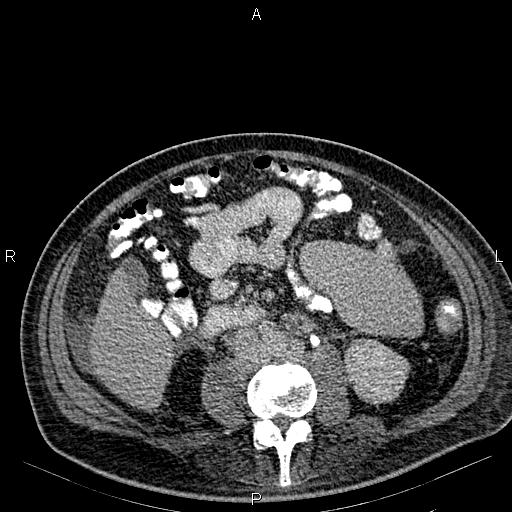 Non Hodgkin lymphoma in a patient with ankylosing spondylitis (Radiopaedia 84323-99621 Axial C+ delayed 40).jpg
