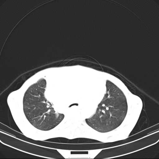 File:Non hodgkin lymphoma of the mediastinum (Radiopaedia 20814-20729 Axial lung window 18).jpg