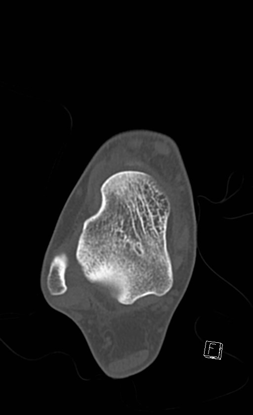 Normal CT of the ankle (Radiopaedia 47111-51658 Axial bone window 52).jpg