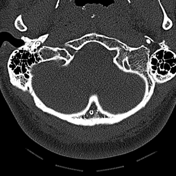 File:Normal CT of the cervical spine (Radiopaedia 53322-59305 Axial bone window 32).jpg