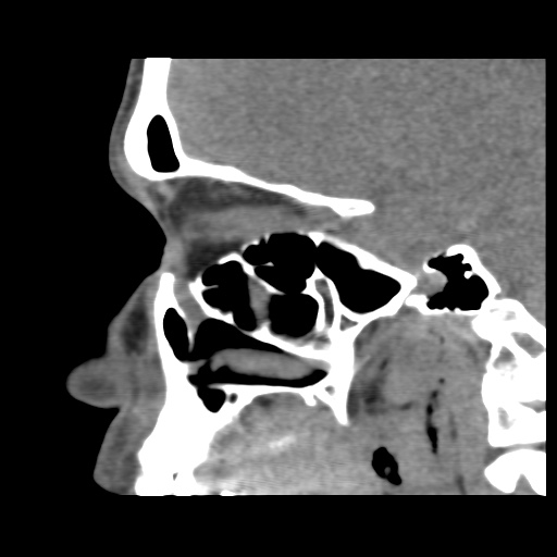 Normal CT paranasal sinuses (Radiopaedia 42286-45390 F 93).jpg