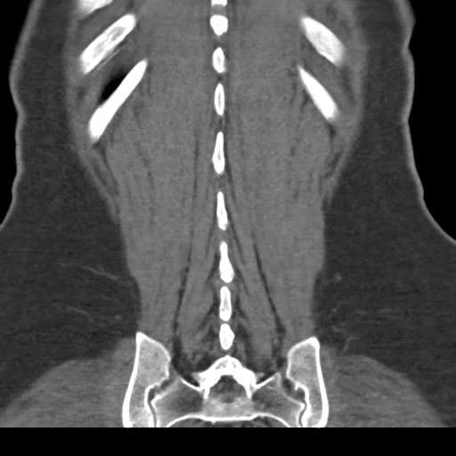 File:Normal CT renal artery angiogram (Radiopaedia 38727-40889 B 67).png