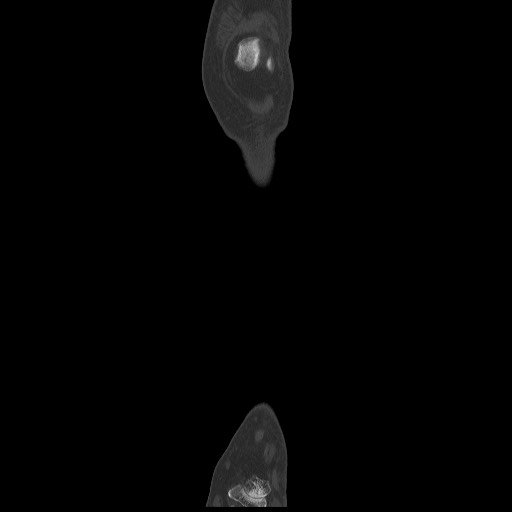 Normal CT tibia and fibula (Radiopaedia 51195-56848 Coronal non-contrast 18).jpg