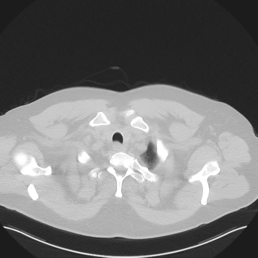 Normal HRCT (Radiopaedia 40797-43458 Axial lung window 5).png