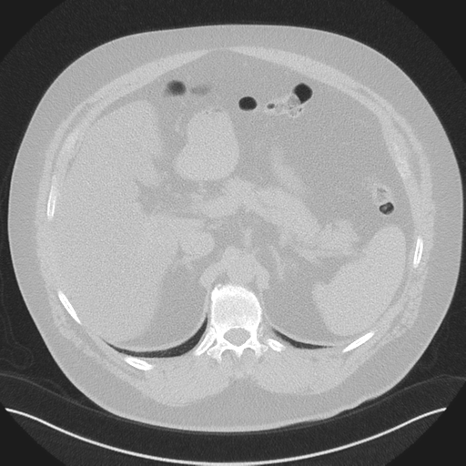 Normal HRCT (Radiopaedia 40797-43458 Axial lung window 60).png