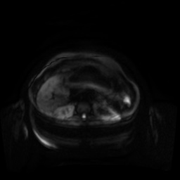 Normal MRI abdomen in pregnancy (Radiopaedia 88001-104541 Axial DWI 126).jpg