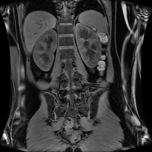 Normal MRI abdomen in pregnancy (Radiopaedia 88001-104541 M 101).jpg