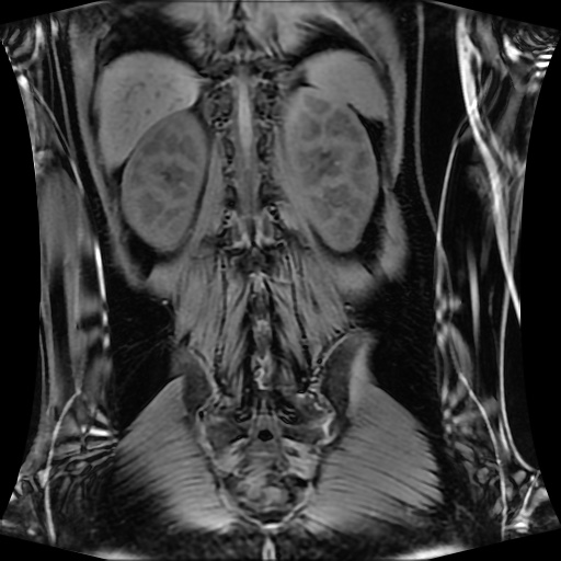 Normal MRI abdomen in pregnancy (Radiopaedia 88001-104541 M 109).jpg