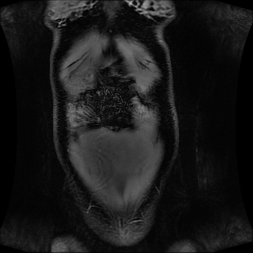 Normal MRI abdomen in pregnancy (Radiopaedia 88001-104541 M 30).jpg