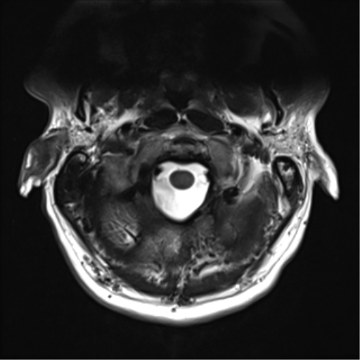 File:Normal MRI cervical spine (infection protocol) (Radiopaedia 53916-60039 Axial T2 7).png