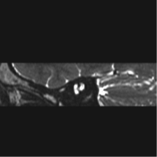 Normal MRI internal auditory canal (Radiopaedia 41613-44525 C 96).png