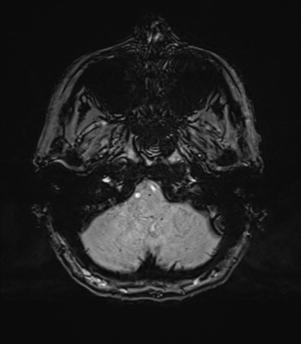 Normal brain MRI (TLE protocol) (Radiopaedia 40748-43405 Axial SWI 11).png