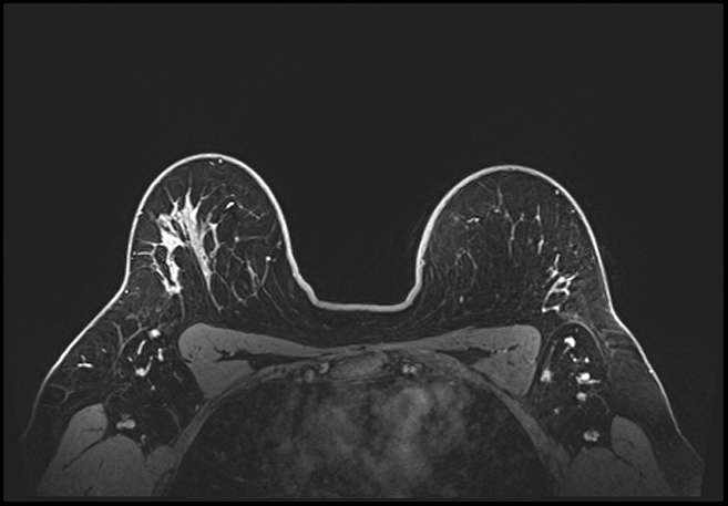 Normal breast MRI - dense breasts (Radiopaedia 80454-93850 C 169).jpg