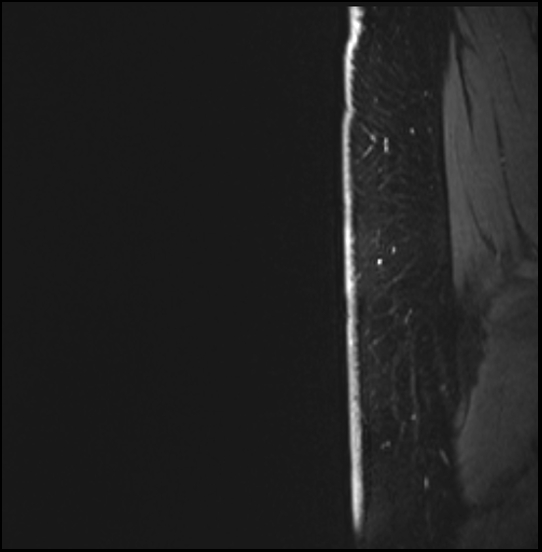 Normal breast MRI - dense breasts (Radiopaedia 80454-93850 I 13).jpg