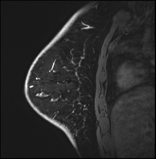Normal breast MRI - dense breasts (Radiopaedia 80454-93850 I 141).jpg