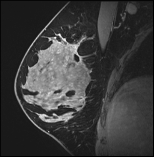 Normal breast MRI - dense breasts (Radiopaedia 80454-93850 I 77).jpg