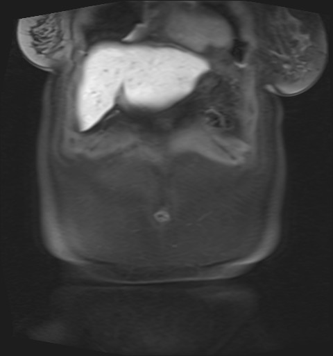 File:Normal hepatobiliary phase liver MRI (Radiopaedia 58968-66230 B 46).jpg
