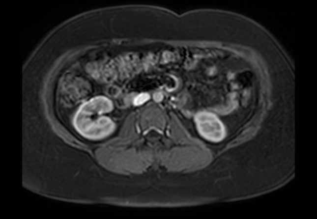 Normal liver MRI with Gadolinium (Radiopaedia 58913-66163 J 10).jpg