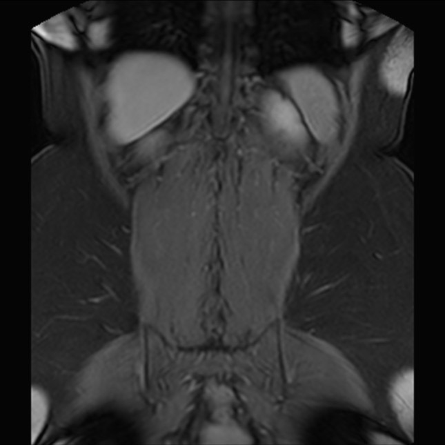 Normal liver MRI with Gadolinium (Radiopaedia 58913-66163 P 72).jpg