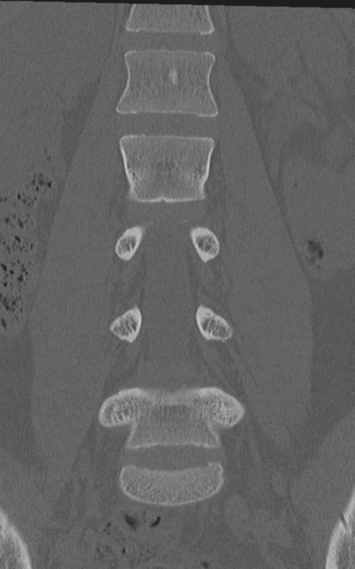 Normal lumbar spine CT (Radiopaedia 46533-50986 Coronal bone window 35).png