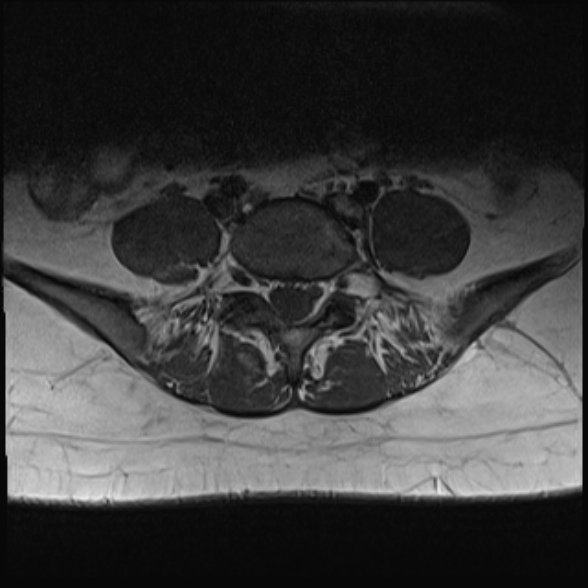 File:Normal lumbar spine MRI- 3 T (Radiopaedia 53280-59250 Axial 25).jpg