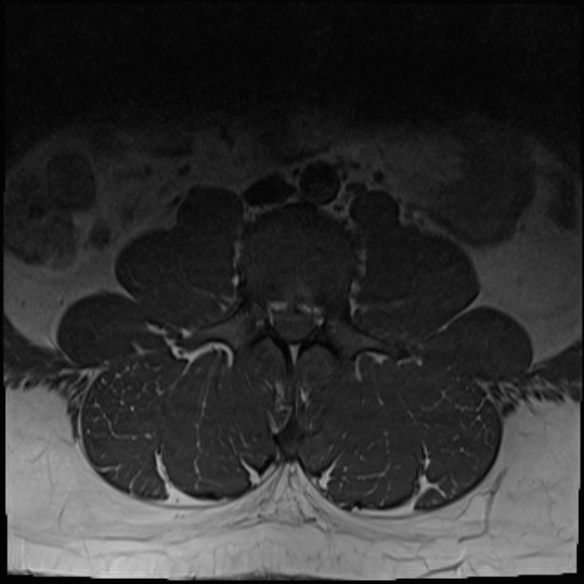 File:Normal lumbar spine MRI (Radiopaedia 47857-52609 Axial T1 3).jpg