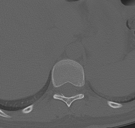 File:Normal lumbosacral CT (Radiopaedia 37923-39867 Axial bone window 5).png