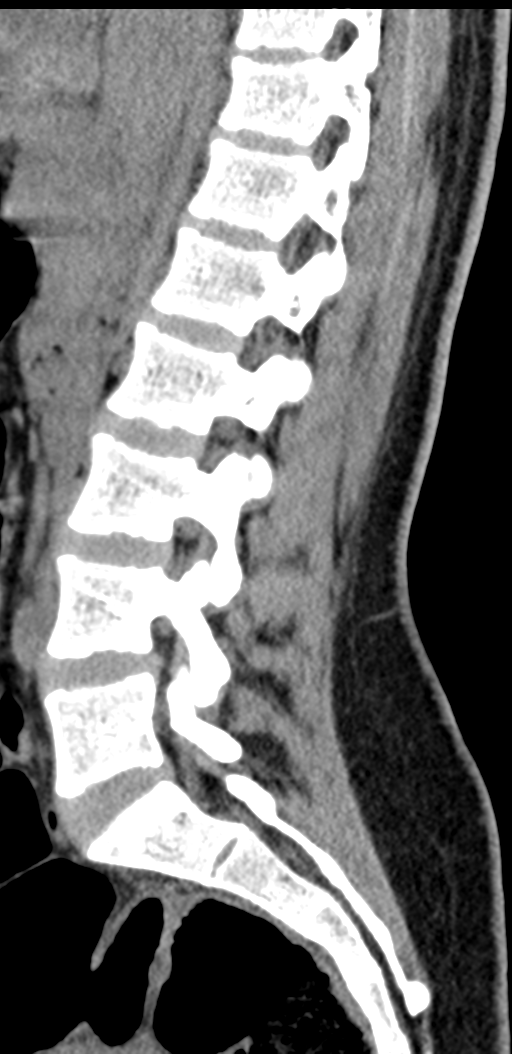 Normal lumbosacral CT (Radiopaedia 37923-39867 E 64).png