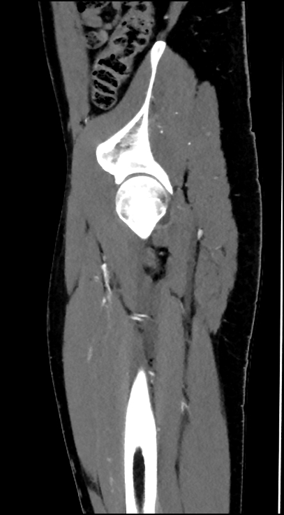 Normal pelvis CT angiogram (Radiopaedia 84966-100481 C 23).jpg