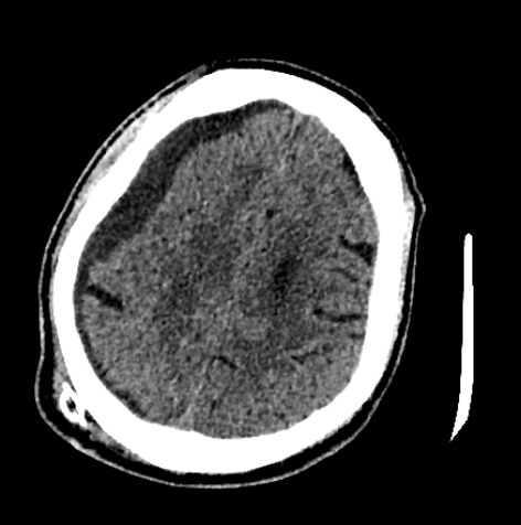 Normal pressure hydrocephalus (Radiopaedia 73685-84479 Axial non-contrast 58).jpg