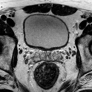 File:Normal prostate (MRI) (Radiopaedia 29986-30535 Axial T2 18).jpg