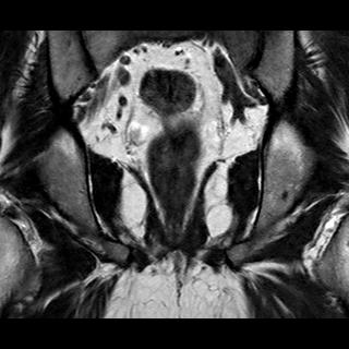 File:Normal prostate (MRI) (Radiopaedia 29986-30535 Coronal T2 16).jpg