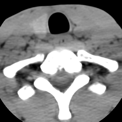 Normal trauma cervical spine (Radiopaedia 41017-43760 Axial non-contrast 52).png