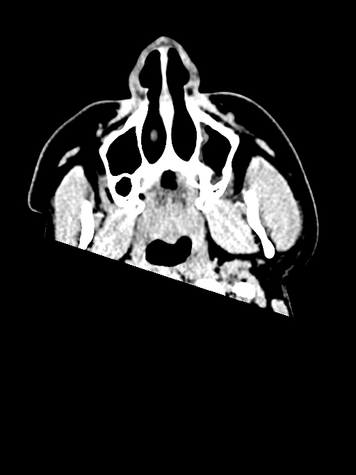 Normal trauma protocol brain and C-spine CT (Radiopaedia 83302-97709 Axial non-contrast 75).jpg